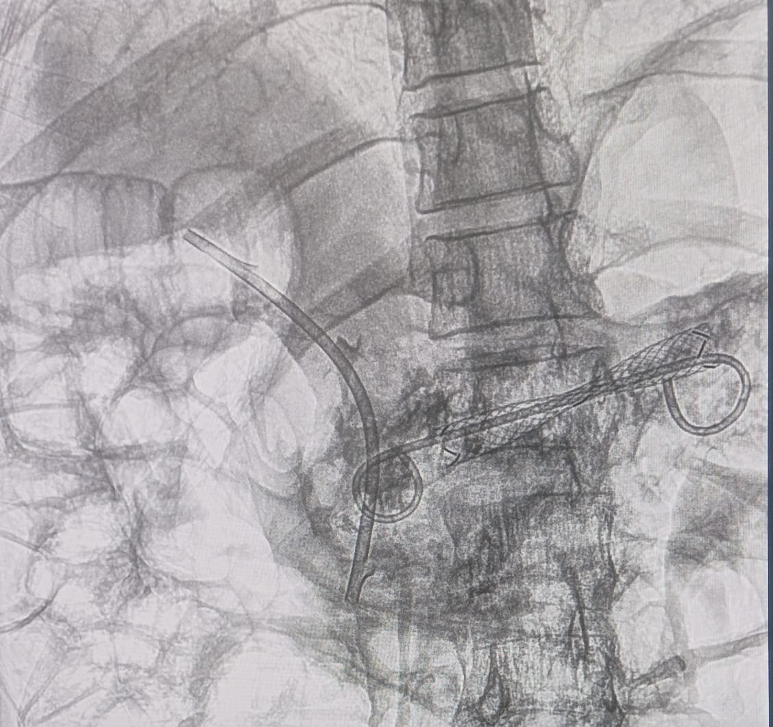 EUS Pancreatogastrostomy Procedure